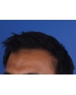 After Hair Transplant&nbsp;2 Sessions (Areas)